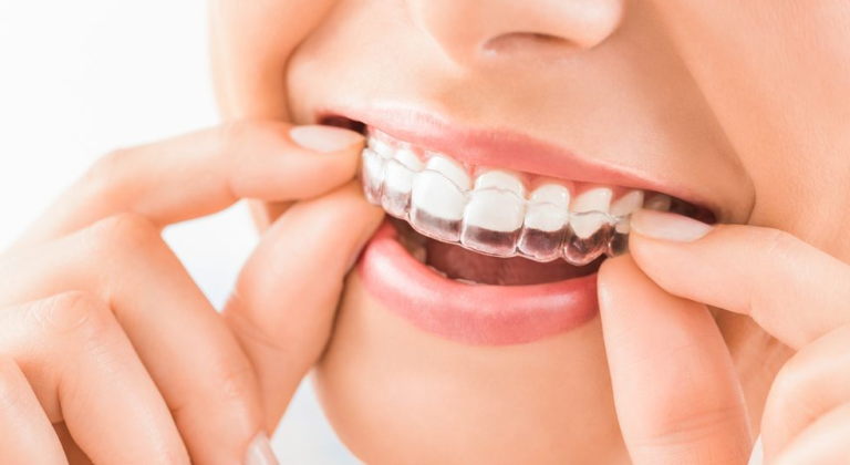 everything you should know about eating and drinking with invisalign