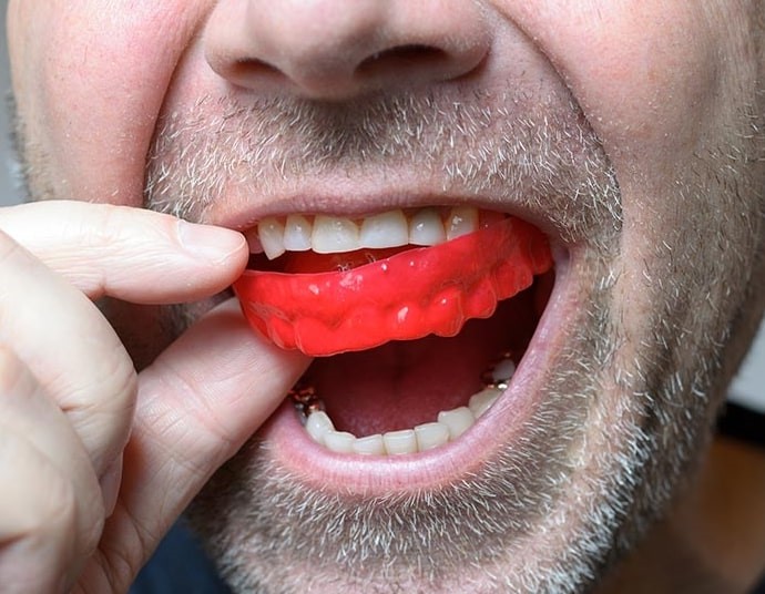 mouth guards in nw calgary