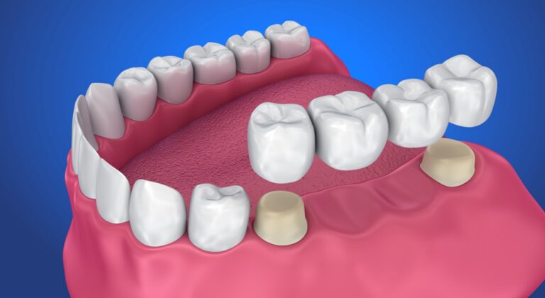 finding the right dentist for dental bridges