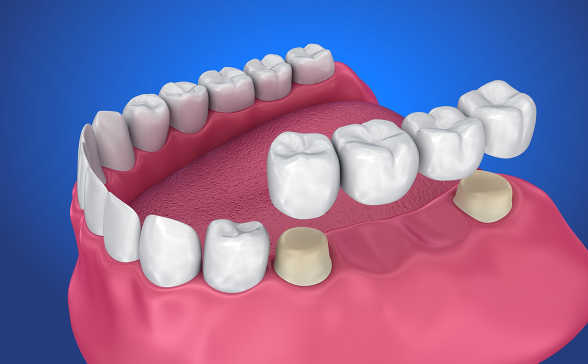 finding the right dentist for dental bridges