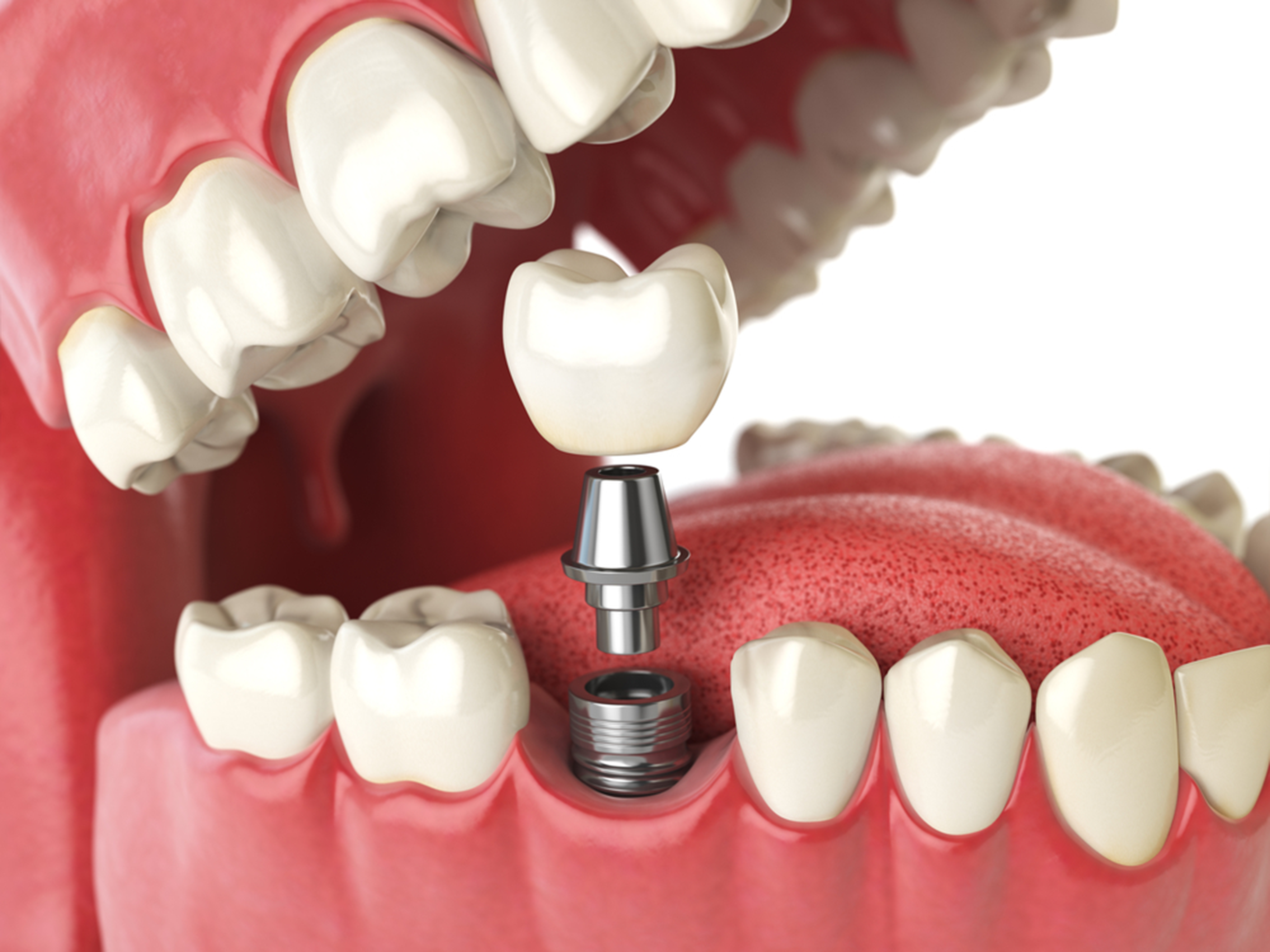 six words about dental implants… starting with lifespan