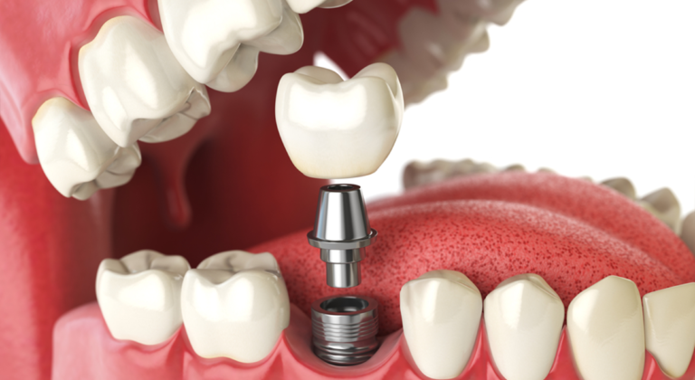six words about dental implants… starting with lifespan
