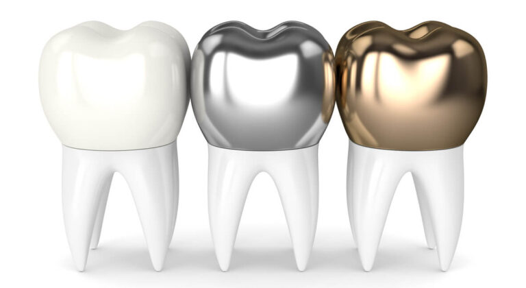 which material to choose for dental fillings