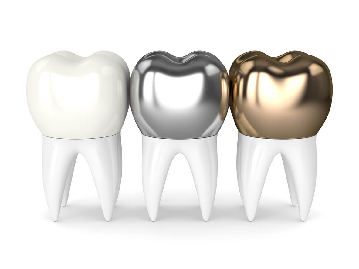 which material to choose for dental fillings