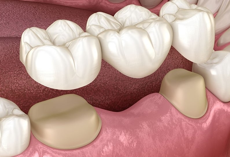 dental bridges in varsity
