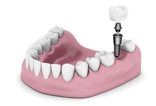 dental implants in varsity