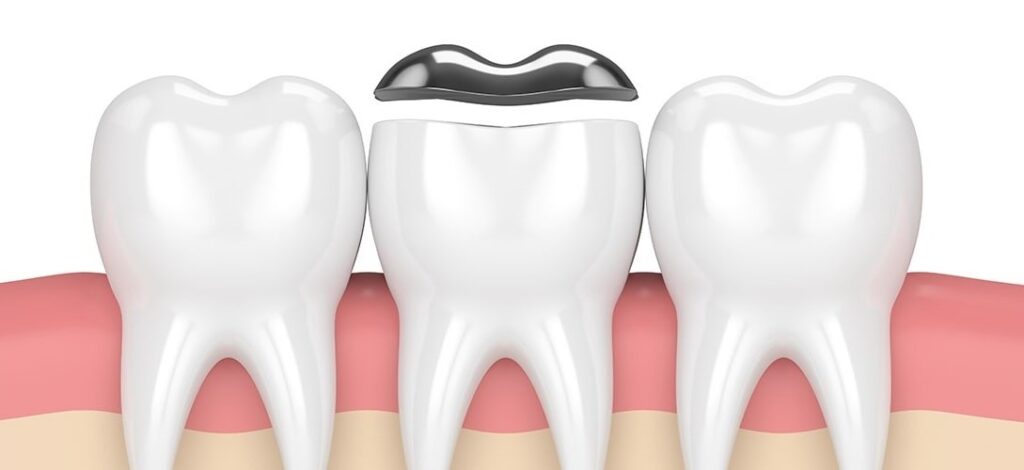 dental inlays and onlays in varsity