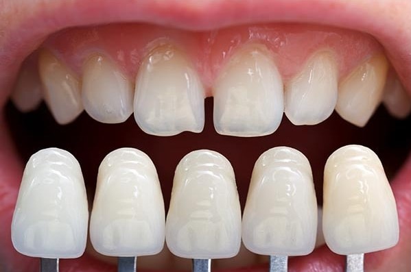 porcelain veneers in varsity