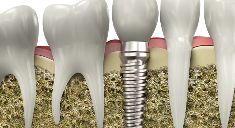 Dental Implants in Varsity