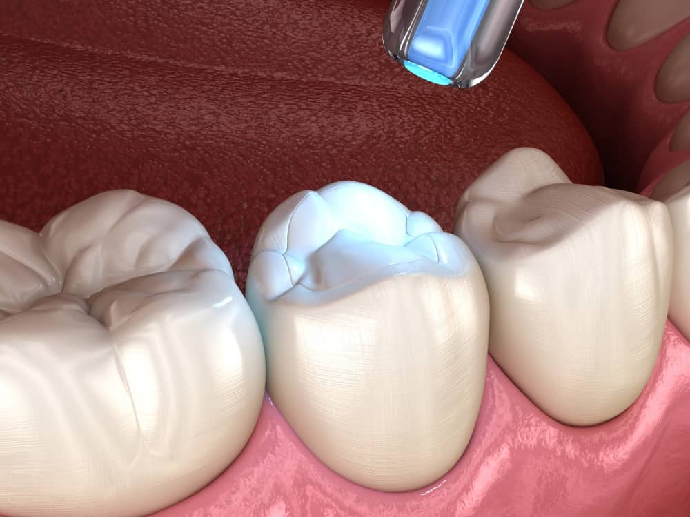 Dental Fillings in Varsity